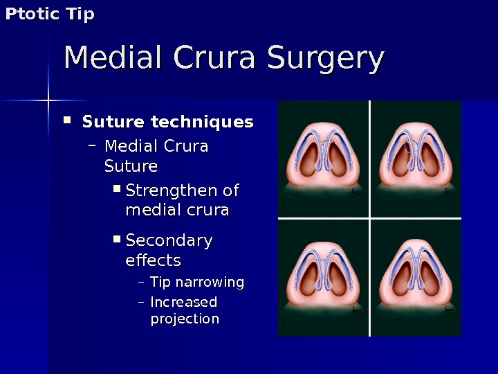 Medial Crura Surgery Suture techniques – Medial Crura Suture Strengthen of medial crura Secondary effects –