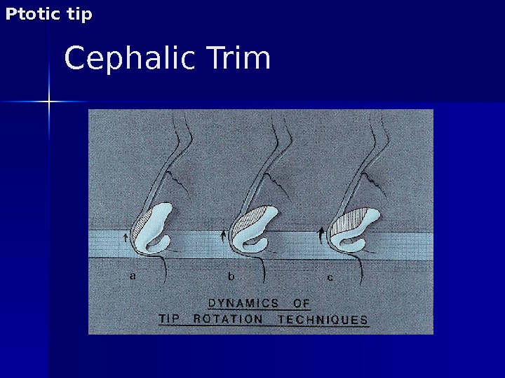 Cephalic Trim. Ptotic tip 