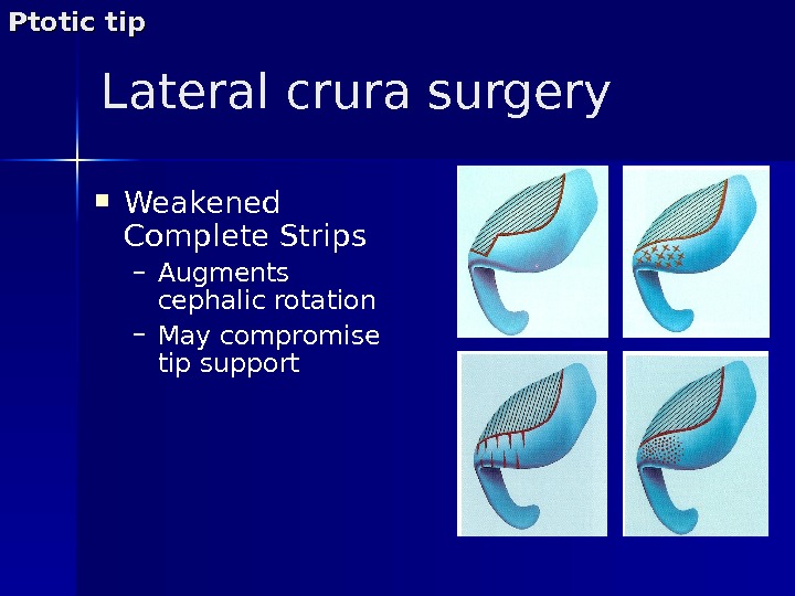 Lateral crura surgery Weakened Complete Strips – Augments cephalic rotation – May compromise tip support. Ptotic