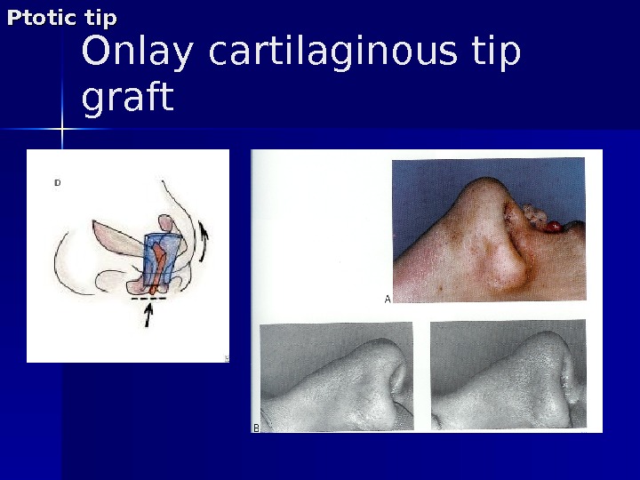 Onlay cartilaginous tip graft. Ptotic tip 