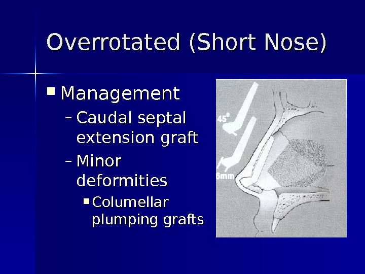 Overrotated (Short Nose) Management – Caudal septal extension graft – Minor deformities  Columellar plumping grafts