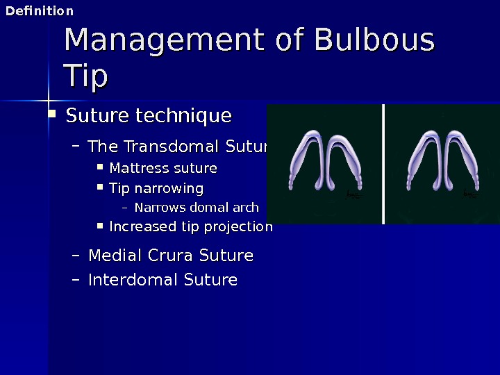 Management of Bulbous Tip Suture technique – The Transdomal Suture Mattress suture Tip narrowing – Narrows