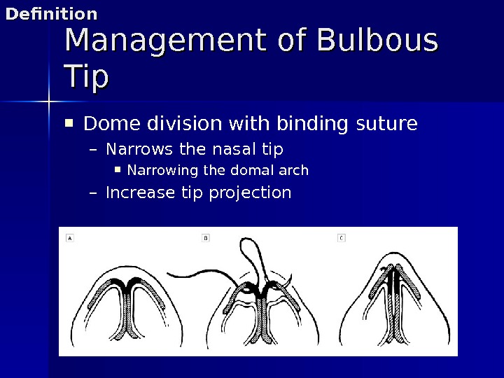  Dome division with binding suture – Narrows the nasal tip Narrowing the domal arch –