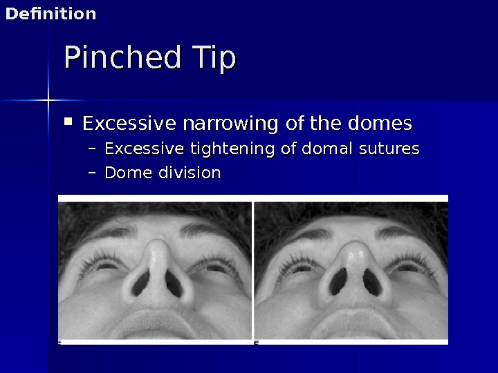 Pinched Tip Excessive narrowing of the domes – Excessive tightening of domal sutures – Dome division.