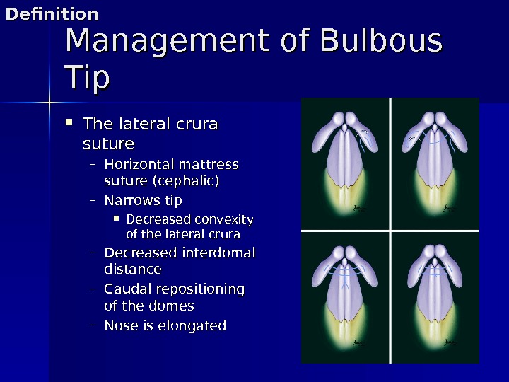 Management of Bulbous Tip The lateral crura suture – Horizontal mattress suture (cephalic) – Narrows tip