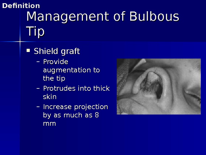 Management of Bulbous Tip Shield graft – Provide augmentation to the tip – Protrudes into thick