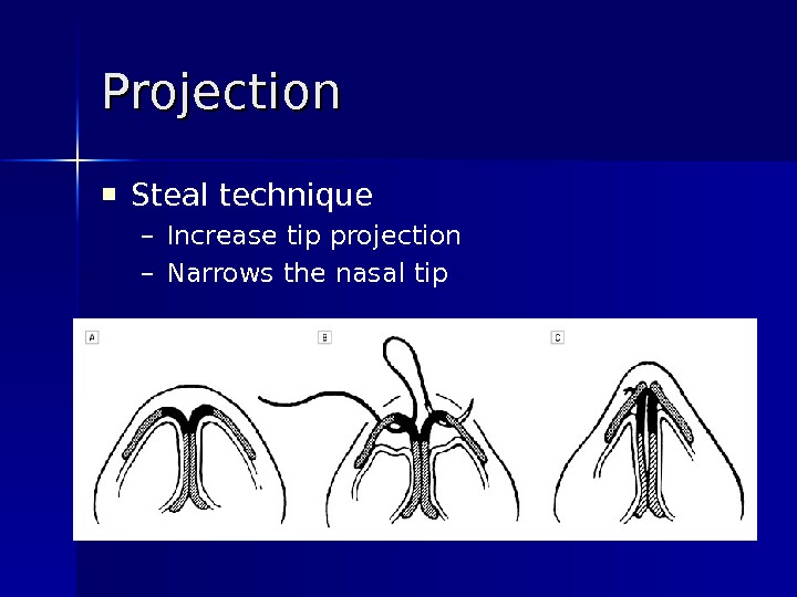 Steal technique – Increase tip projection – Narrows the nasal tip. Projection 