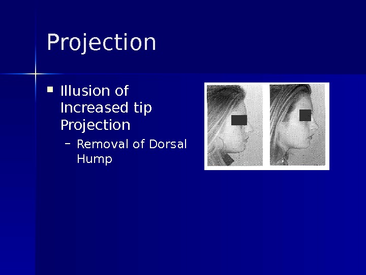 Projection Illusion of Increased tip Projection – Removal of Dorsal Hump 