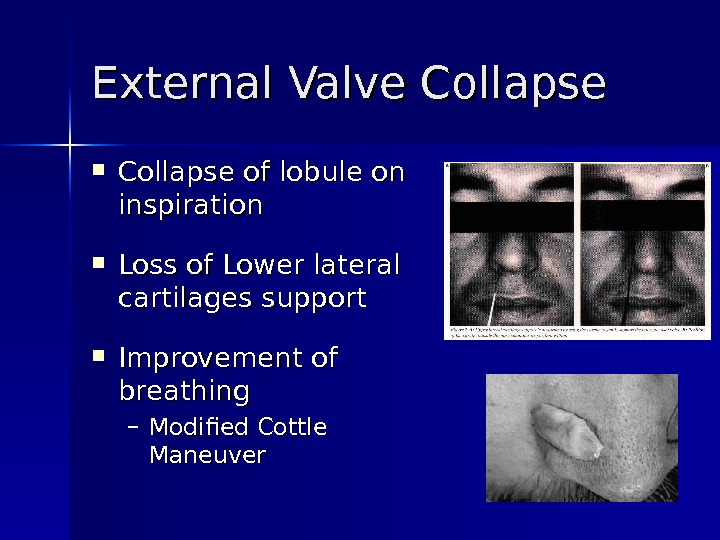 External Valve Collapse of lobule on inspiration Loss of Lower lateral cartilages support Improvement of breathing