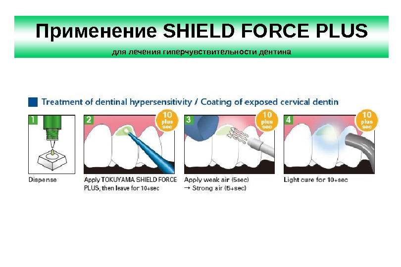 Применение SHIELD FORCE PLUS для лечения гиперчувствительности дентина 
