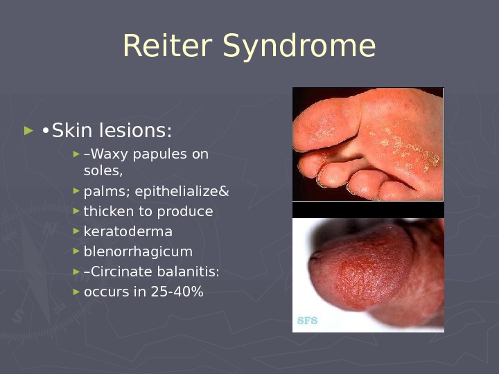  Reiter Syndrome ► • Skin lesions: ► – Waxy papules on soles,  ►