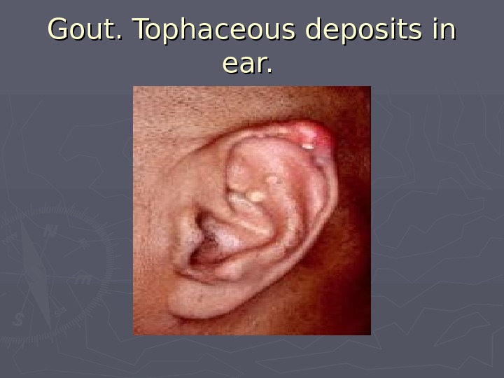   Gout. Tophaceous deposits in ear.  