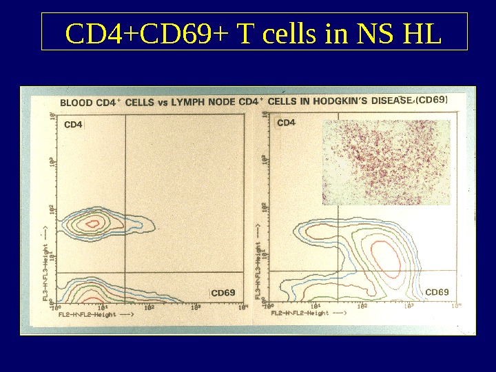   CD 4+CD 69+ T cells in NS HL 