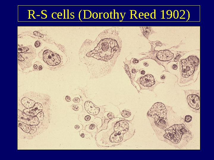   R-S cells (Dorothy Reed 1902) 