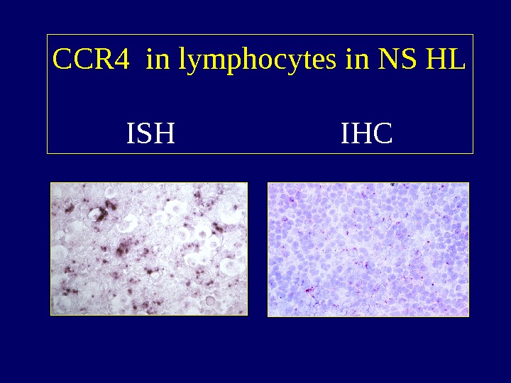   CCR 4 in lymphocytes in NS HL ISH     IHC 
