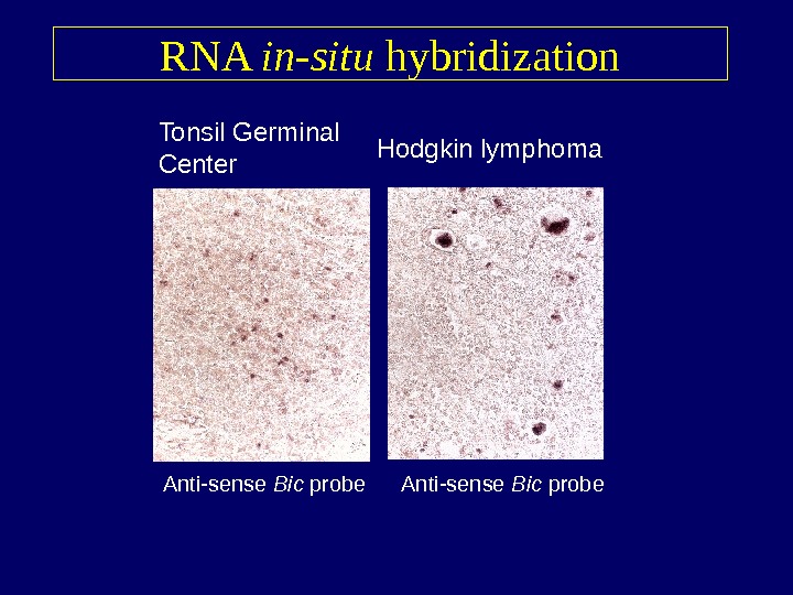   RNA in-situ hybridization Tonsil Germinal Center Hodgkin lymphoma Anti-sense Bic  probe 
