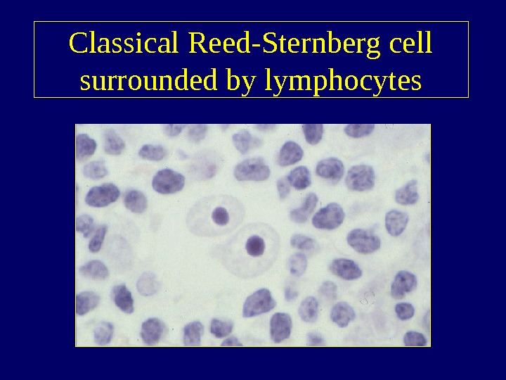   Classical Reed-Sternberg cell surrounded by lymphocytes 