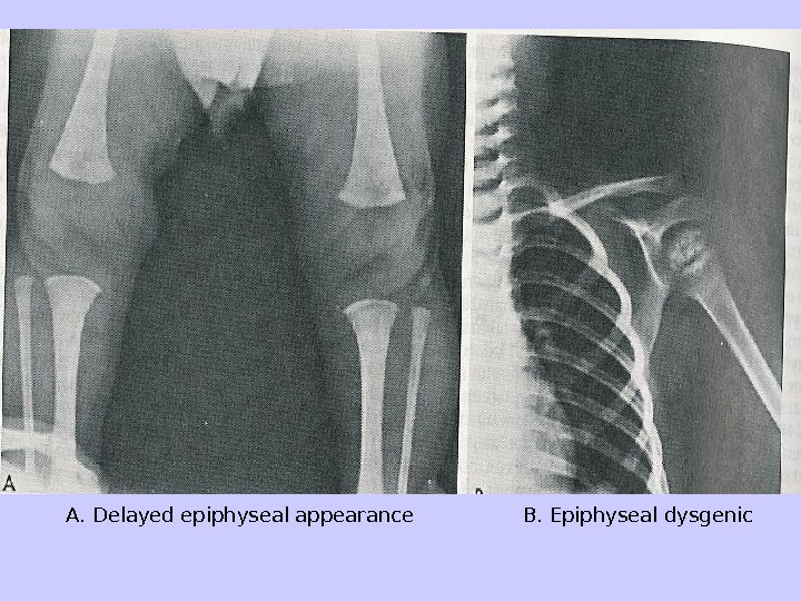 A. Delayed epiphyseal appearance   B. Epiphyseal dysgenic 