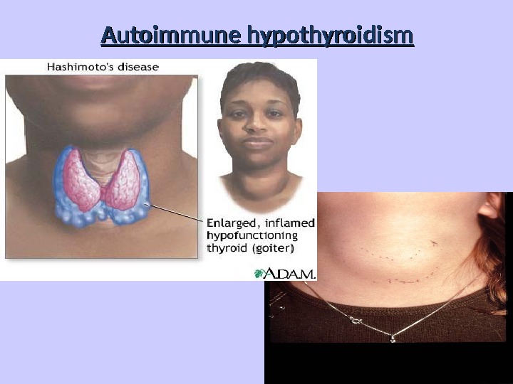Autoimmune hypothyroidism 