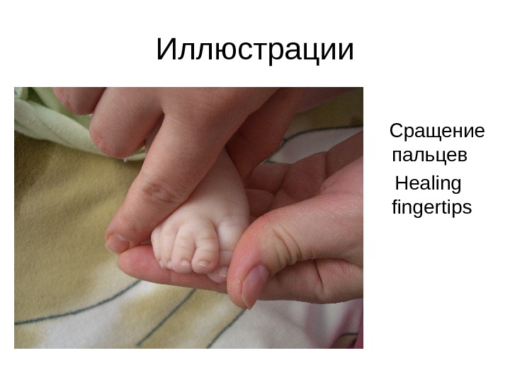 Иллюстрации Сращение пальцев Healing fingertips 