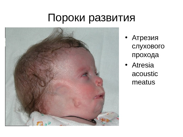 Пороки развития • Атрезия слухового прохода • Atresia acoustic meatus 
