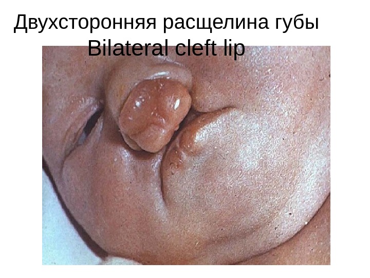 Двухсторонняя расщелина губы Bilateral cleft lip 