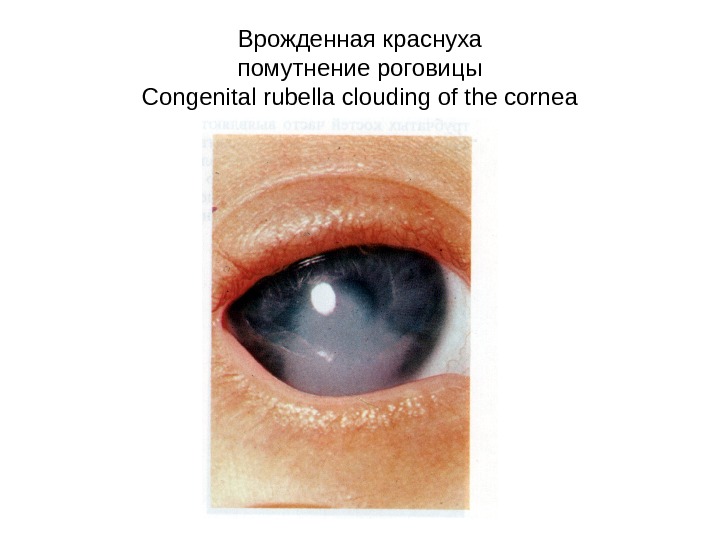 Врожденная краснуха помутнение роговицы Congenital rubella clouding of the cornea 