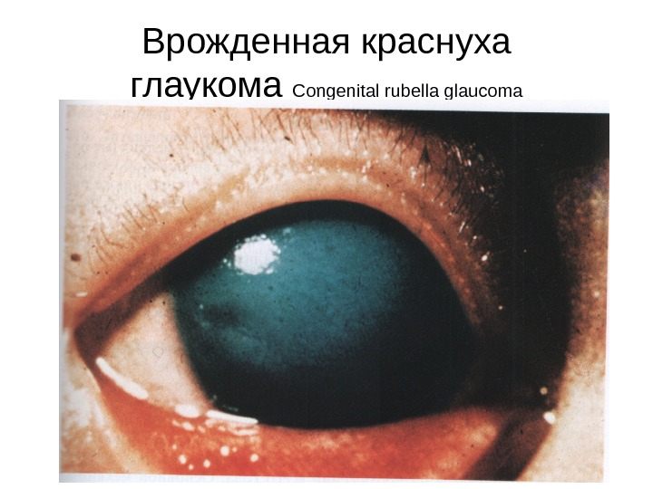 Врожденная краснуха глаукома  Congenital rubella glaucoma 