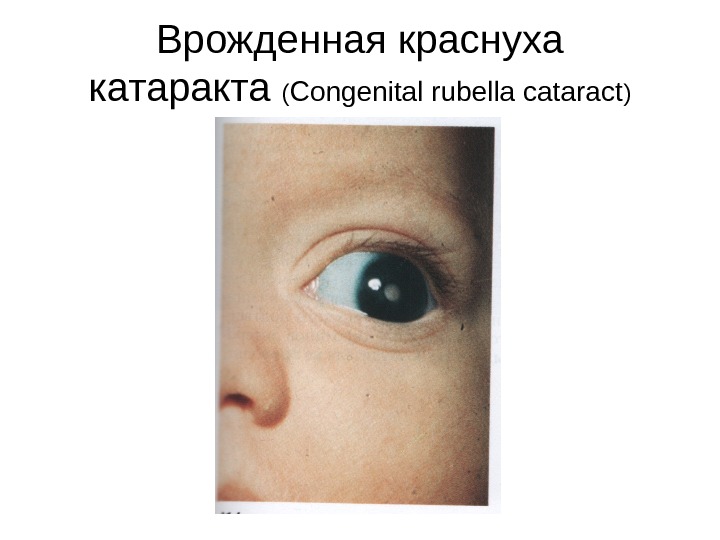 Врожденная краснуха катаракта  ( Congenital rubella cataract ) 