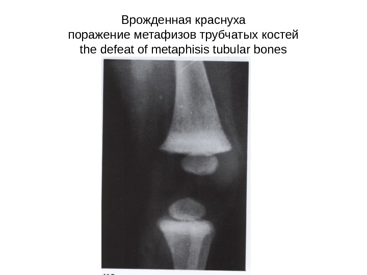 Врожденная краснуха поражение метафизов трубчатых костей the defeat of metaphisis tubular bones 