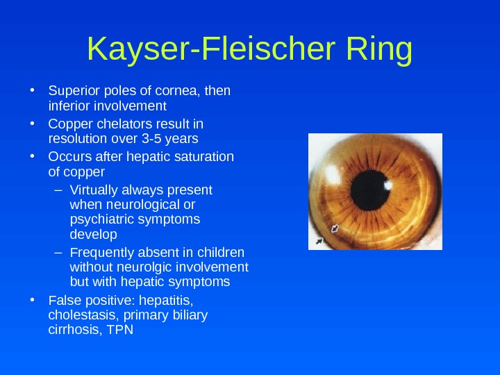 Kayser-Fleischer Ring • Superior poles of cornea, then inferior involvement  • Copper chelators result in