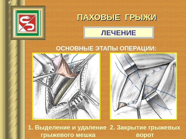 Грыжи факультетская хирургия презентация