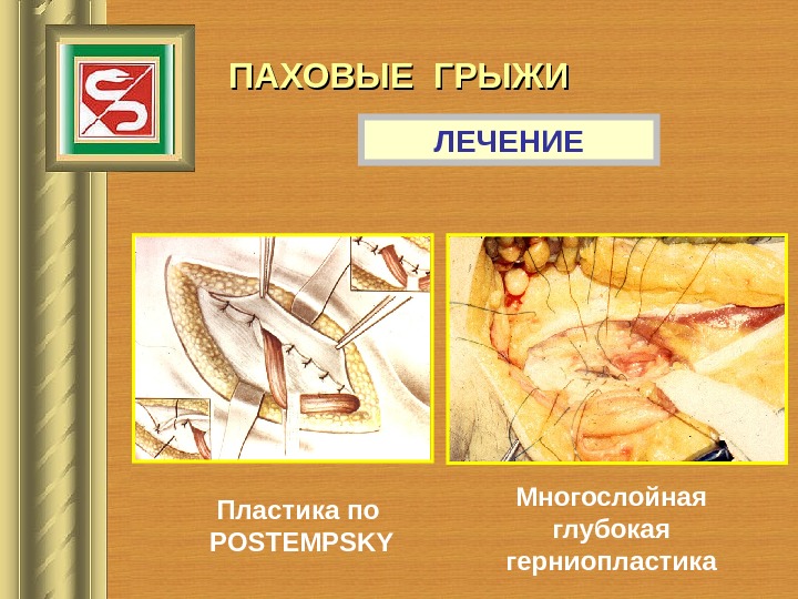 Грыжи факультетская хирургия презентация