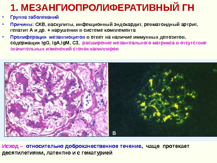 Острый гломерулонефрит микроскопическая картина