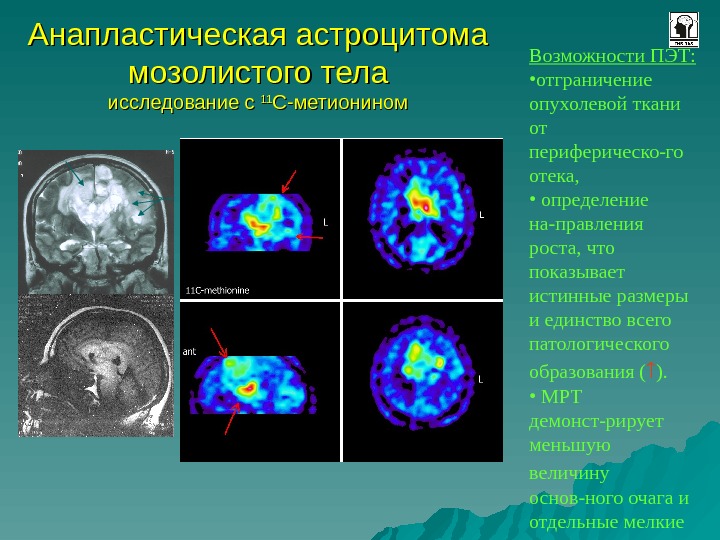 Позитронно эмиссионная томография презентация