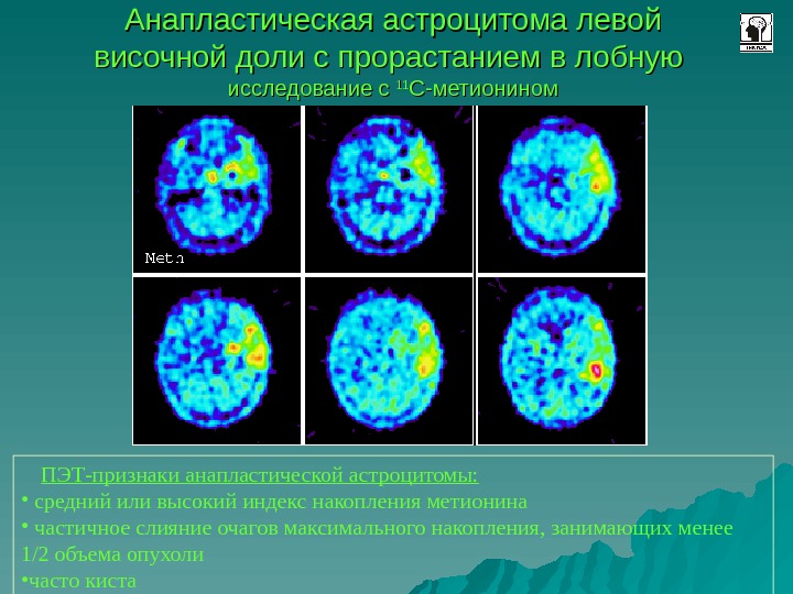 Позитронно эмиссионная томография презентация