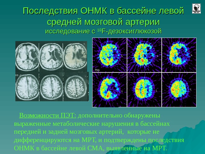 Позитронно эмиссионная томография презентация