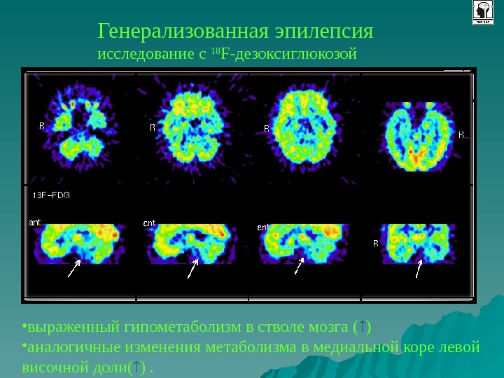 Позитронно эмиссионная томография презентация