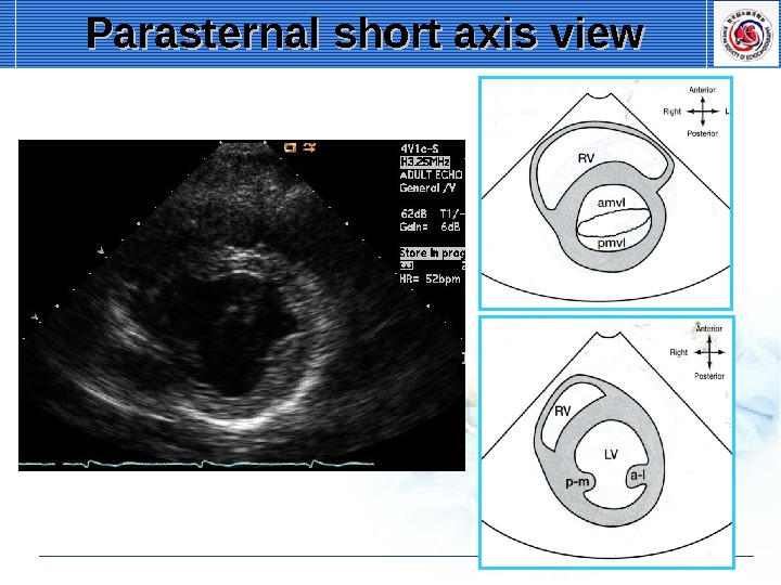 Transthoracic Echocardiography. Standard Imaging of A.