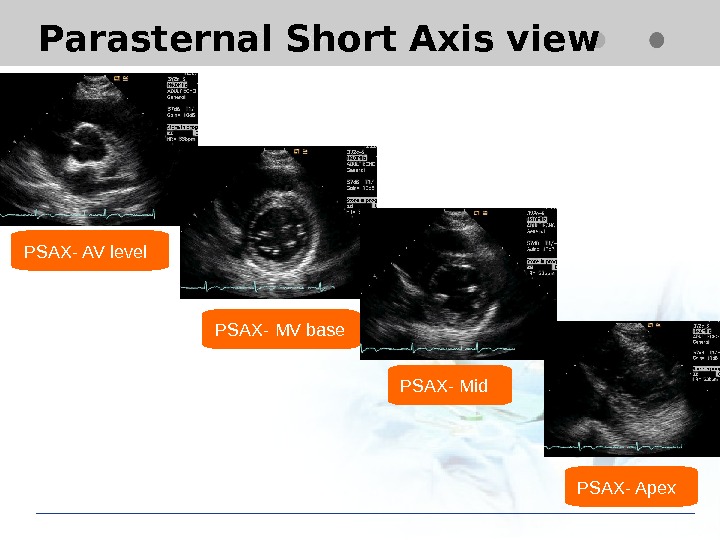 Transthoracic Echocardiography. Standard Imaging Of A.