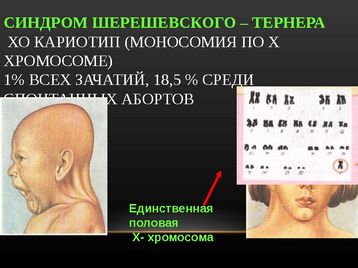 Кариотип 45. Кариотип больного синдрома Тернера. Синдром Шерешевского Тернера кариотип. Шерешевский Тернер синдром кариотип.