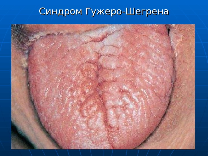 Реактивно-дистрофические и воспалительные заболевания слюнных желез ...