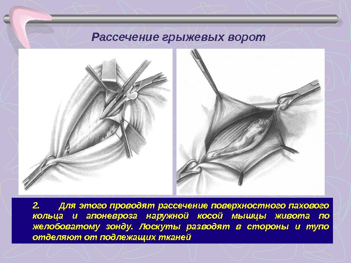 Грыжа передней брюшной стенки карта вызова