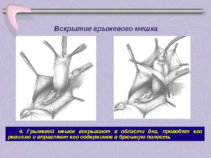 Грыжевой мешок. Вскрытие грыжевого мешка. Строение грыжевого мешка. Содержимое грыжевого мешка.