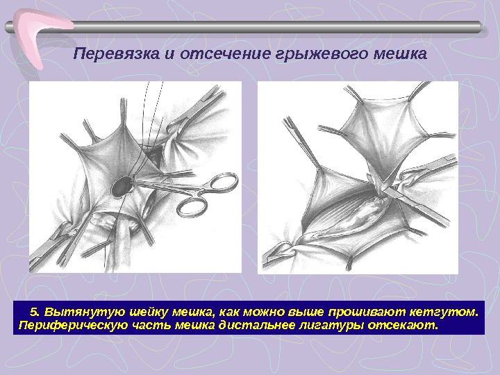 Доступы через переднюю брюшную стенку схема