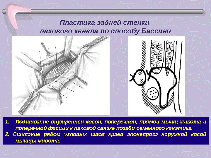 Схемы пластики пахового канала