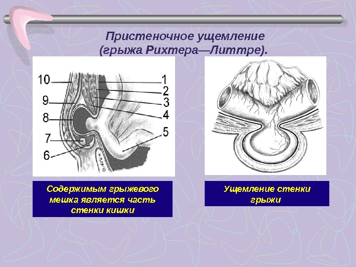 Какова клиническая картина при рихтеровском ущемлении