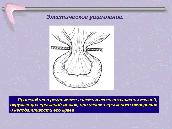 Ущемленная грыжа передней брюшной стенки карта вызова