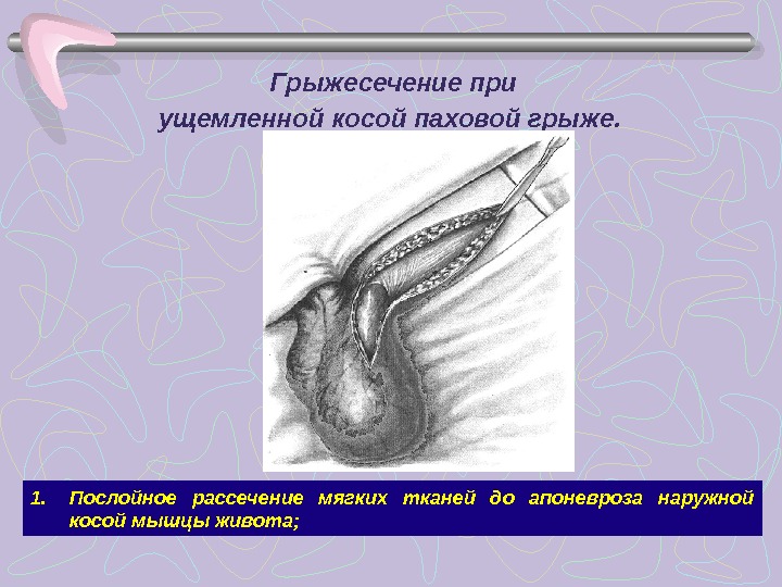 Ущемленная паховая грыжа карта