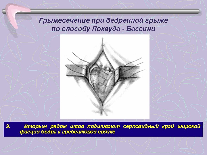 Операции грыжесечения по Бассини. Операция Бассини при бедренных грыжах. Пластика бедренных грыж бедренным способами. Техника операции при ущемленной бедренной грыже.